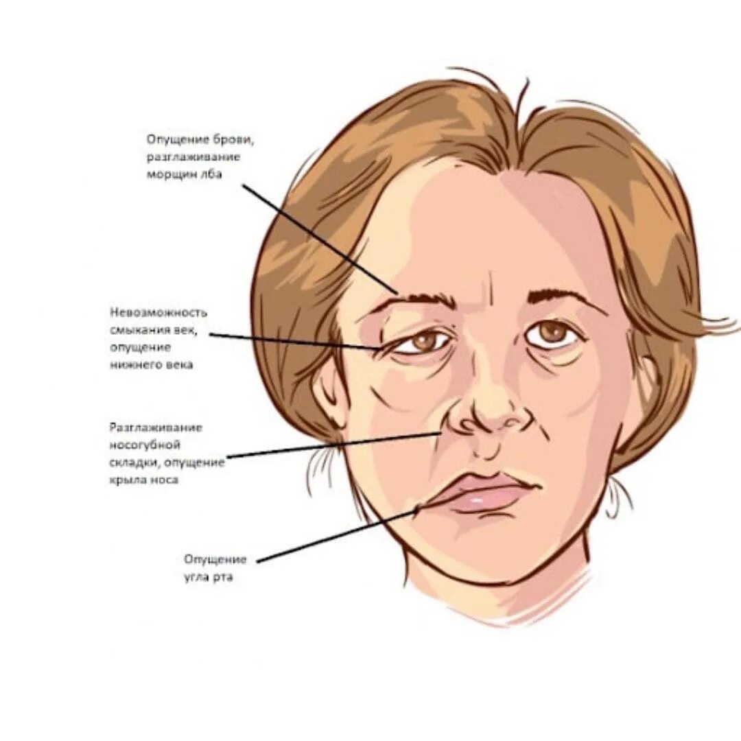 Опущение уголков рта. Неврит лицевого нерва с парезом. Неврит лицевого нерва. Парез и паралич мимических мышц.. Невропатия лицевого нерва парез мимической мускулатуры.