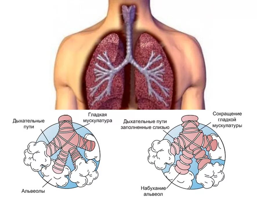 хронические болезни нижних дыхательных путей. инфекции верхних дыхательных путей этиология. заболевания нижних дыхательных. инфекции нижних дыхательных путей. заболевания дыхательных путей.