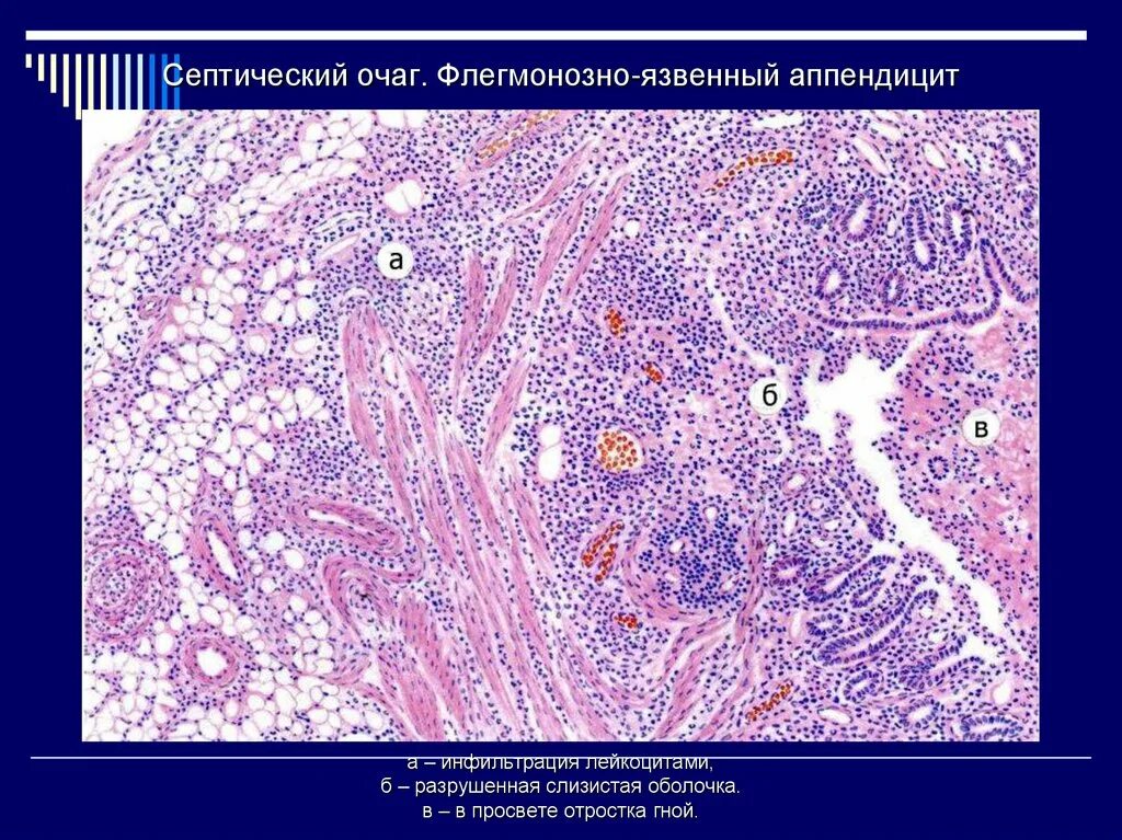 Флегмонозно язвенный аппендицит. Гнойный флегмонозный аппендицит микропрепарат. Флегмонозный аппендицит препарат. Флегмонозный аппендицит Макропрепара. Флегмонозный язвенный аппендицит микропрепарат.