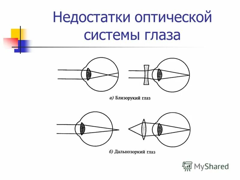 Дефекты зрения физика кратко