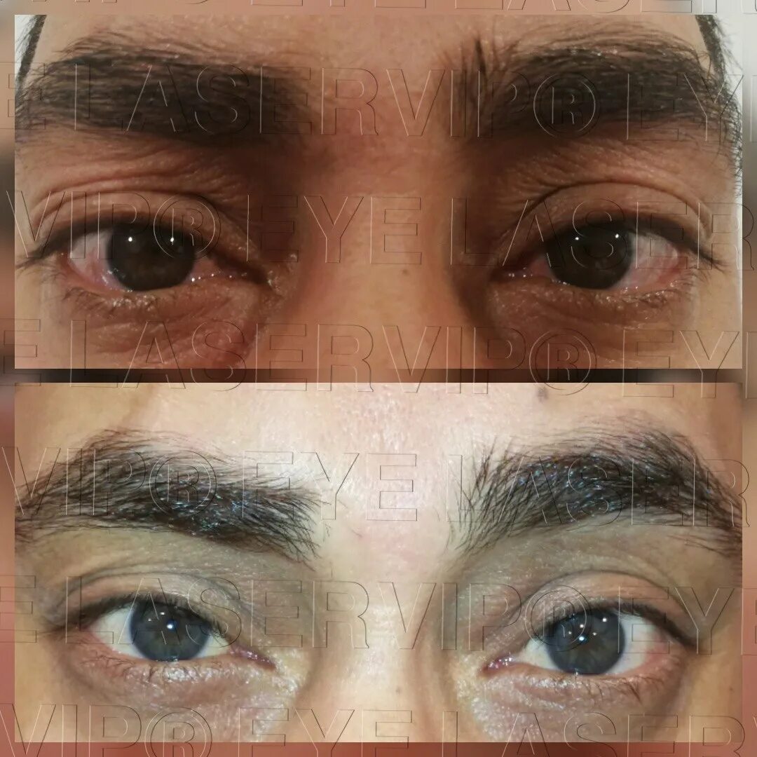 Имплантация цвета глаз. Изменится ли цвет глаз после лазерной коррекции. Изменения цвета лазера. Сиена цвета глаз опеоация. Изменение цвета глаз лазером.