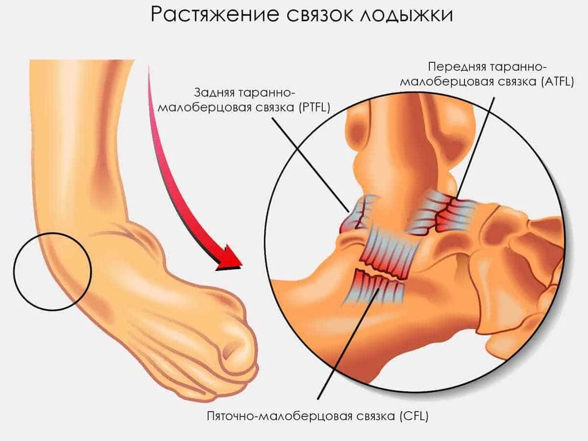 Голеностопный сустав сколько заживает. Разрыв связок голеностопного сустава. Растяжение и разрыв связок. Растяжение связок голеностопа степени растяжения. Травма голеностопного сустава растяжение связок.