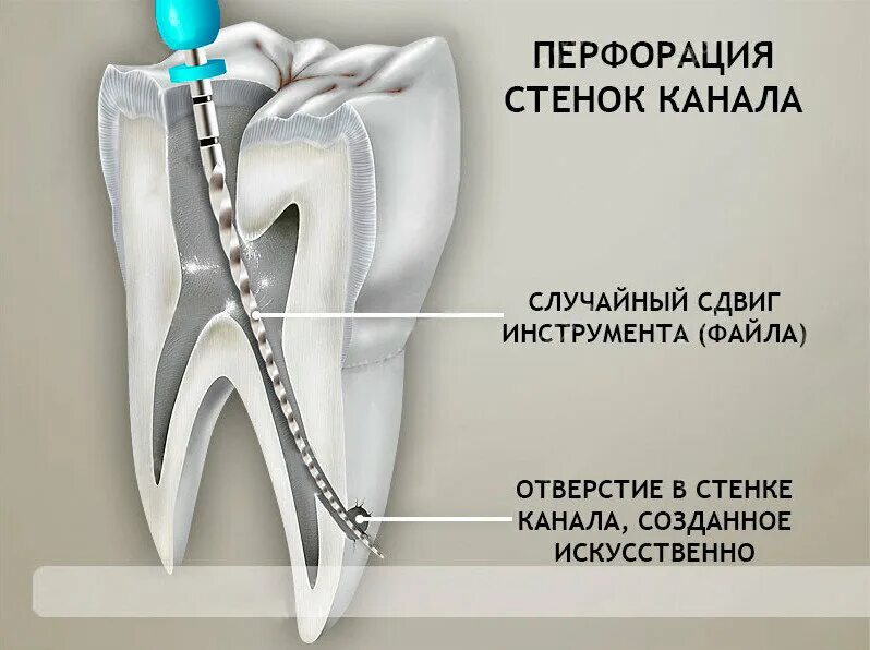 Чистка каналов зуба болит. Перфорация корневого канала зуба. перфорации стенки корневого канала зуба. апикальная перфорация стенки корневого канала. перфорация корневого канала классификация.