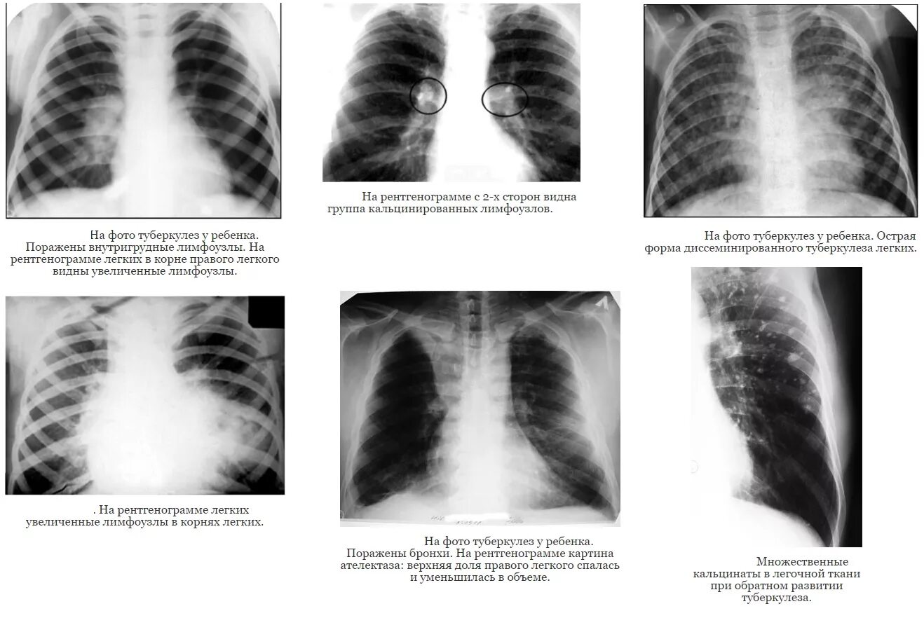 Клинический случай туберкулез. Туберкулез легких на рентгеновском снимке легких. Рентген снимок диссеминированный туберкулез. Пневмония и туберкулёз на снимке рентгена. Первичный туберкулез синдром рентгенография.