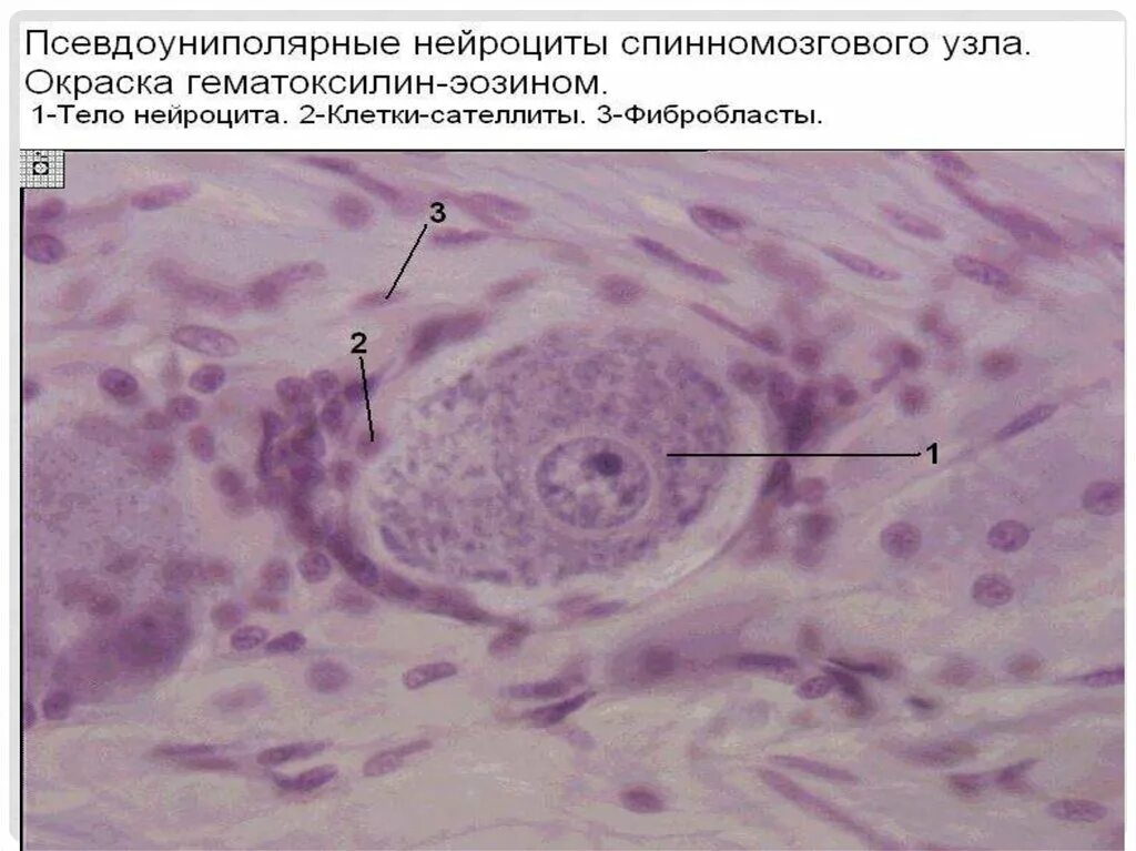 Клетки спинномозгового узла. Псевдоуниполярные нервные клетки спинномозговой узел препарат. Псевдоуниполярные Нейроны спинального ганглия препарат. Псевдоуниполярный Нейрон спинномозговой узел препарат. Псевдоуниполярные Нейроны гистология.