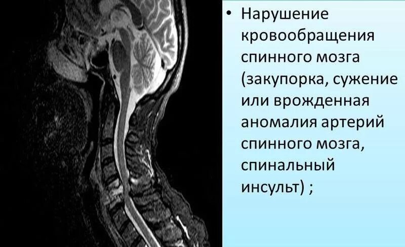 Спинальный инсульт что это симптомы и лечение. Спинальный инсульт грудного отдела. Спинальный инсульт на мрт позвоночника. Ишемический спинальный инсульт мрт. Спинальный инсульт мрт.