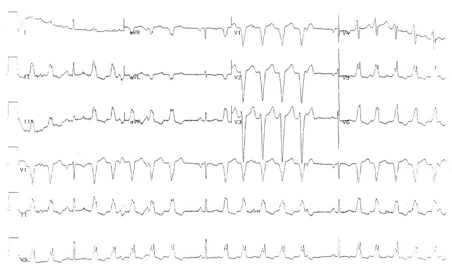 Многофокусная предсердная тахикардия на ЭКГ. Хаотическая предсердная тахикардия на ЭКГ. Автоматическая предсердная тахикардия на ЭКГ. Мультифокальная предсердная тахикардия на ЭКГ.