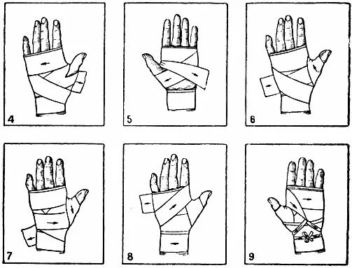 Бинтование лучезапястного сустава эластичным бинтом. Как правильно эластичным бинтом забинтовать кисть. Перевязка запястья эластичным бинтом. Как правильно бинтовать запястье эластичным. Как перевязать кисть