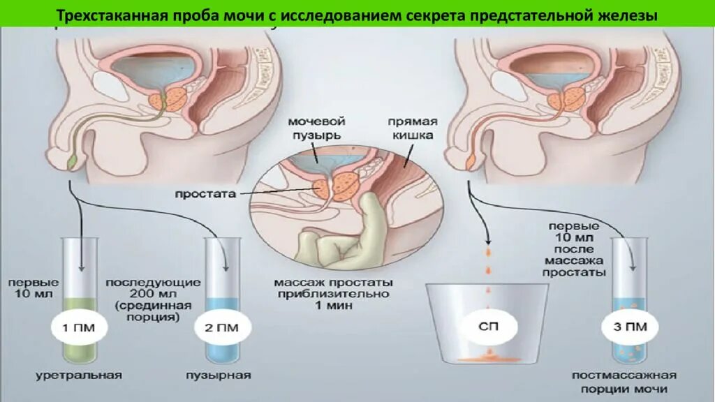 Секрет предстательной железы. Взятие секрета простаты. Исследование секрета предстательной железы. Взятие секрета предстательной железы. Трехстаканная проба мочи