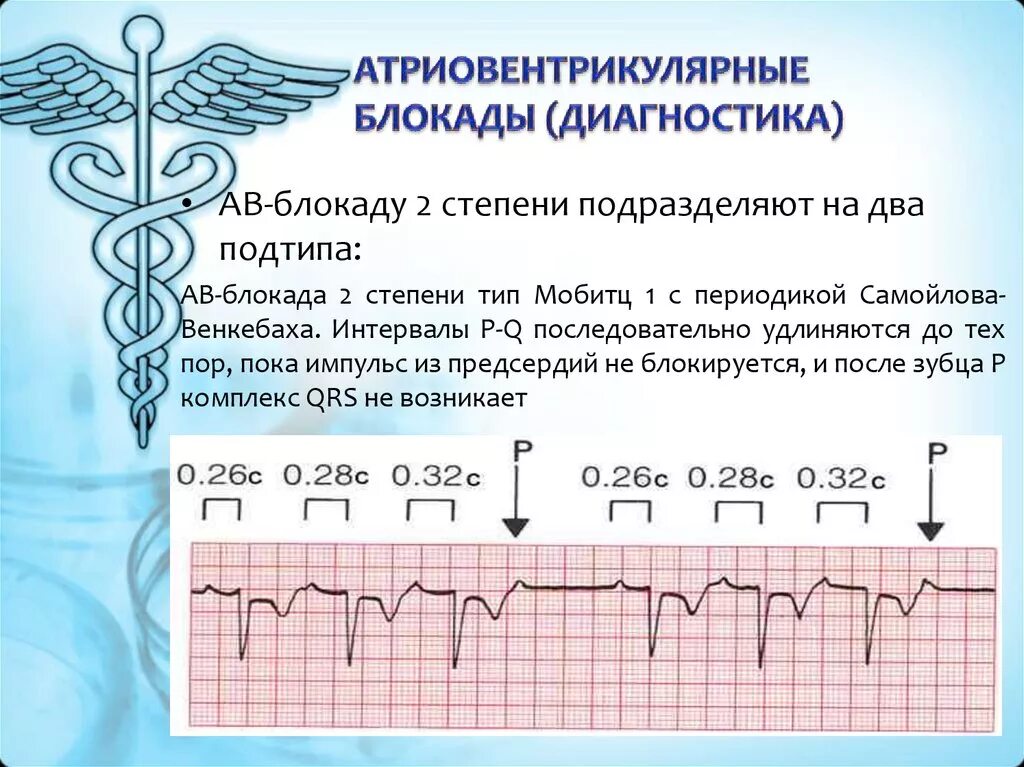 Полная атриовентрикулярная блокада. Атриовентрикулярная блокада на ЭКГ. Полная АВ блокада диагноз. Критерии атриовентрикулярной блокады. Атриовентрикулярная блокада клинические проявления.