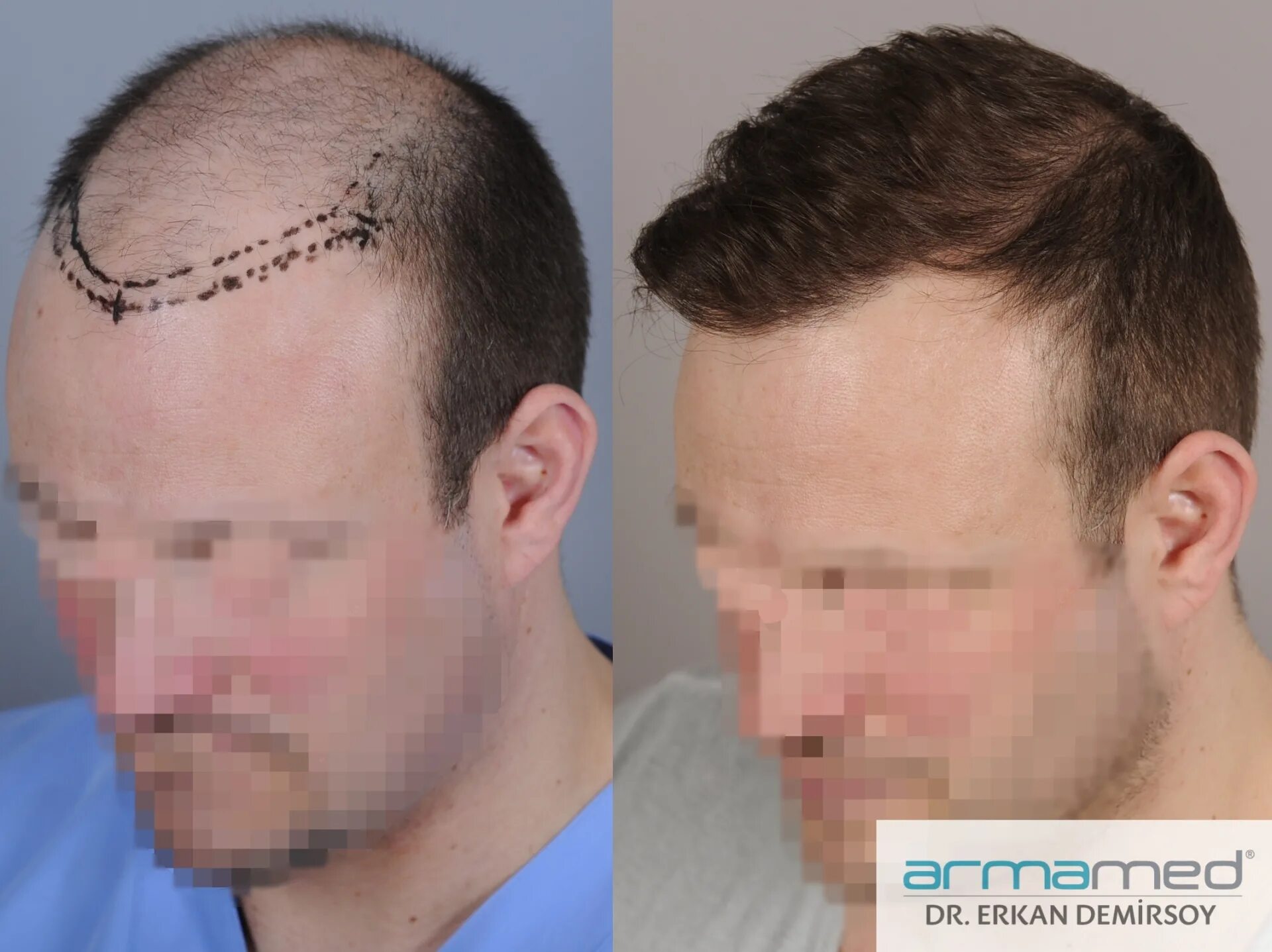 Трансплантация волос до и после. Волосы после пересадки волос. Пересадка волос в санкт петербурге