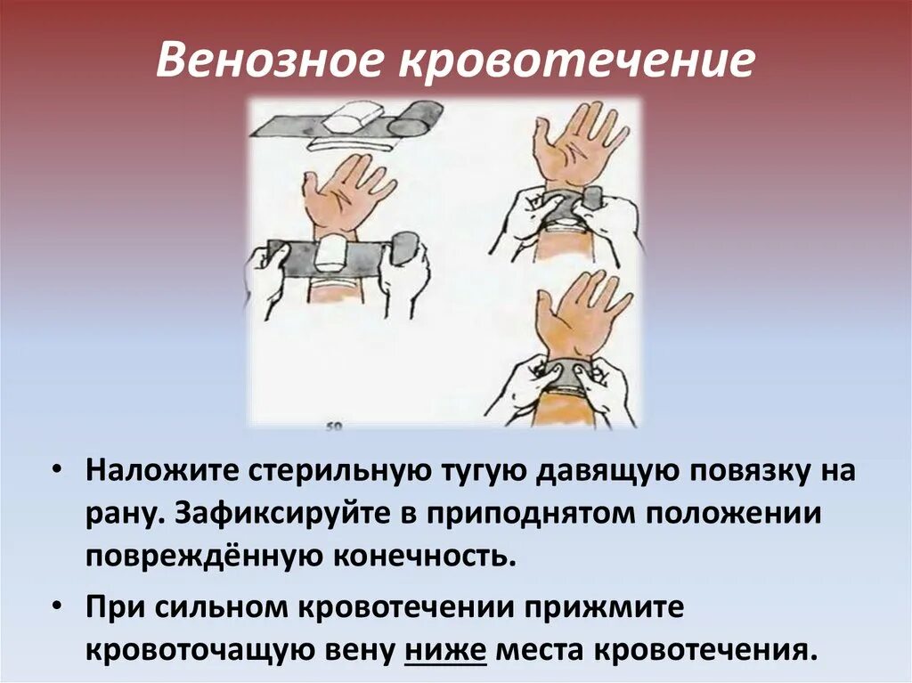 Способы временной остановки кровотечения наложение давящей повязки. Повязки при кровотечении алгоритм. При венозном кровотечении. Первая помощь при венозном кровотечении. Давящая повязка при венозном кровотечении.