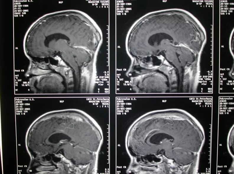 Коллоидная киста 3 желудочка головного мозга. Опухоль 3 желудочка головного мозга кт. Объемное образование 3-го желудочка. Опухоль 4 желудочка головного мозга.