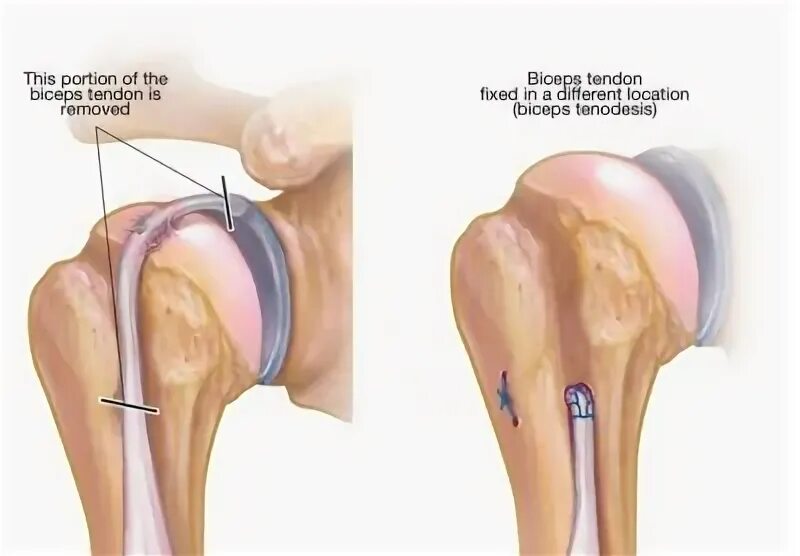 Тенодез сухожилия бицепса плечевого сустава. Тенодез сухожилия длинной головки двуглавой мышцы плеча. Тенодез длинной головки бицепса плечевого сустава. Разрыв сухожилия двуглавой мышцы операция.