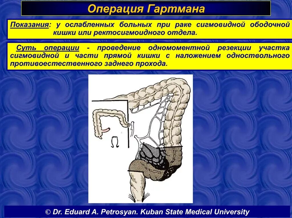 Операция Гартмана на прямой кишке. Резекция сигмовидной кишки по Гартману. Операция Гартмана на толстой кишке. Резекция толстой кишки по Гартману. Как восстановить кишечник после операции