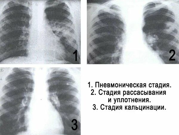 Начальная стадия туберкулеза у взрослых. Снимки туберкулеза на ранних стадиях. Туберкулез на ранних стадиях. Ранняя стадия туберкулеза легких. Первая стадия туберкулеза.