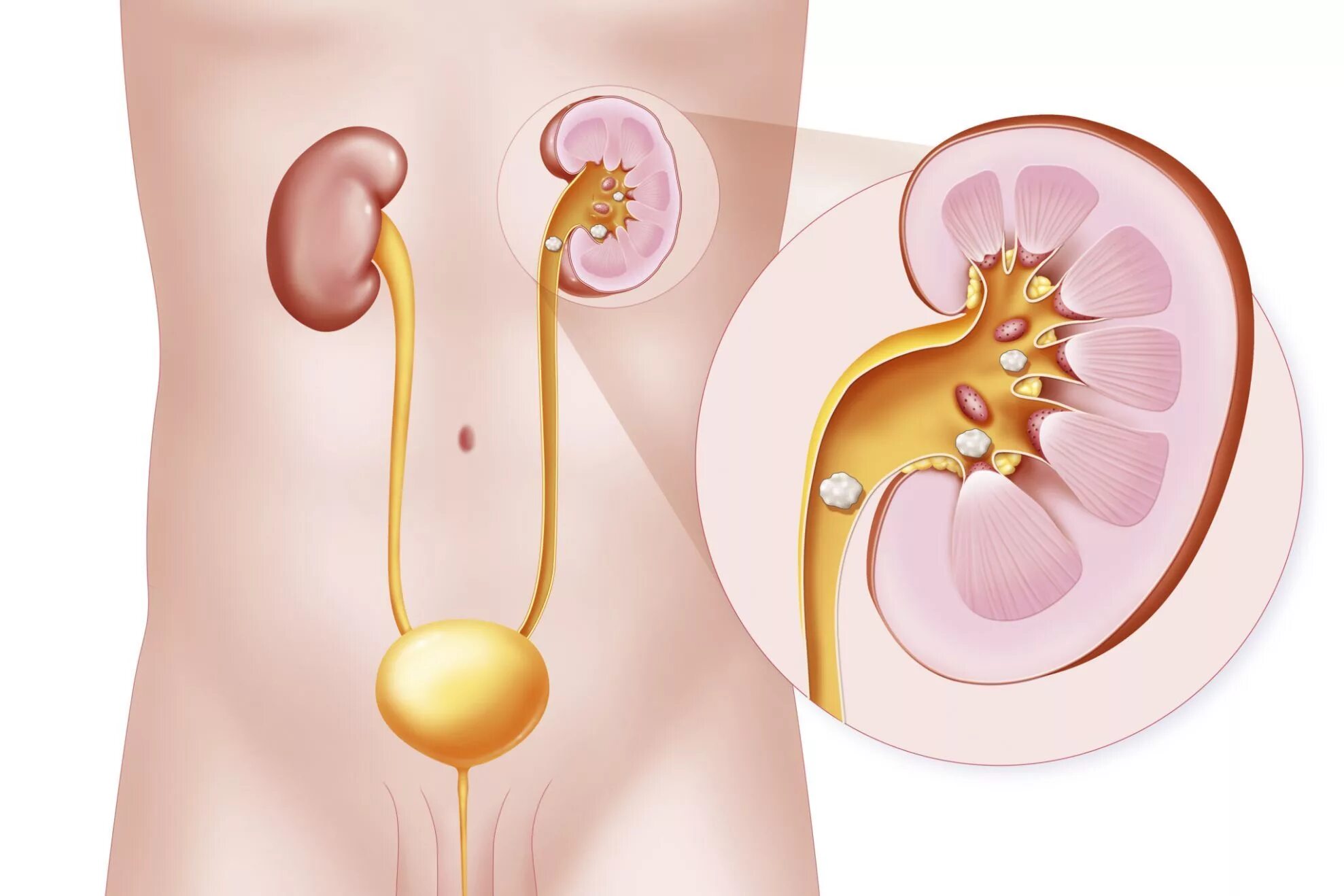 Камни в почках заболевание. Мочекаменная болезнь конкременты. Мочекаменная болезнь камни в почках. Мочекаменная болезнь анатомия. Камни в почках (конкременты).