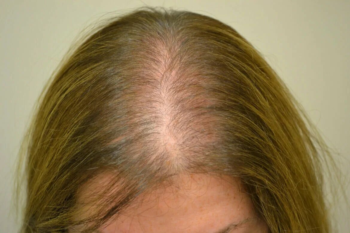 9 лет выпадают волосы. Андрогенная алопеция алопеция. Диффузная телогеновая алопеция. Андрогенноя аполоцея у женщин.
