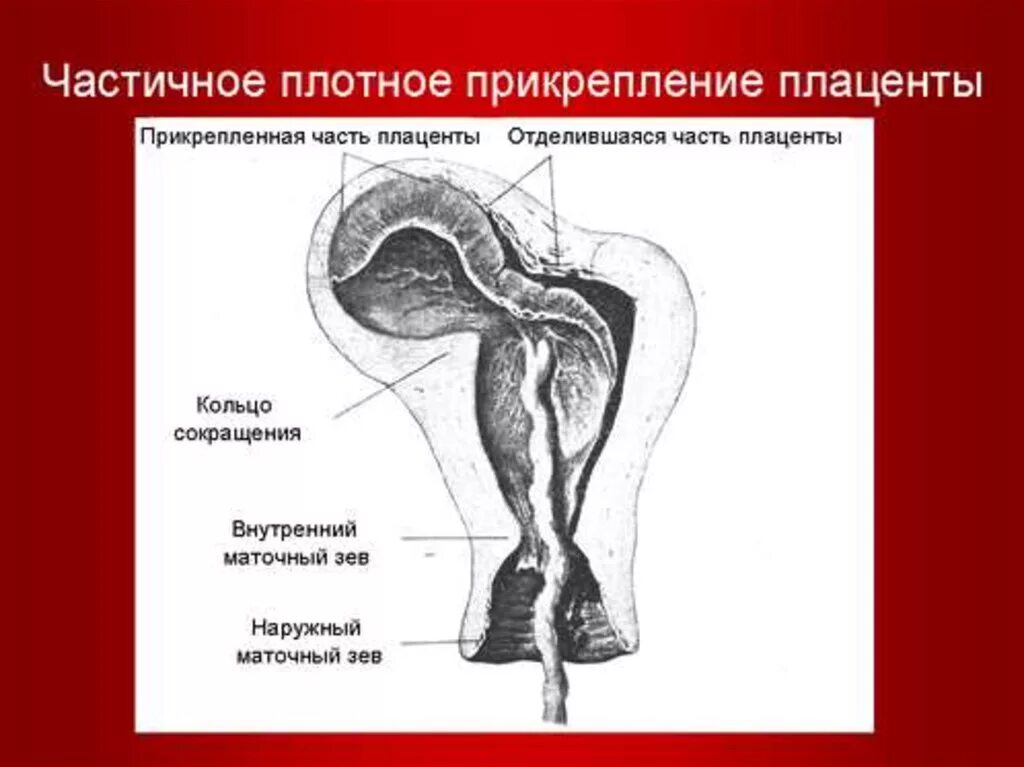 Маточный зев. Прикрепление плаценты. Частичное плотное прикрепление плаценты. Расширение лакун плаценты. Место прикрепления к плаценте.