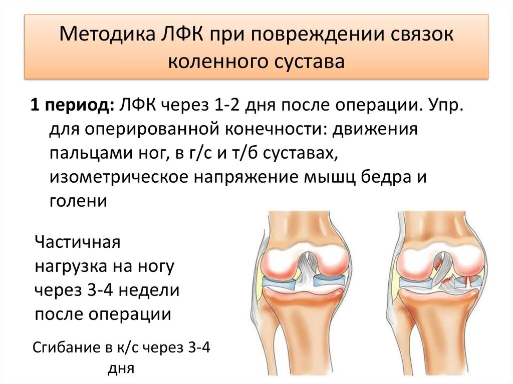 Упражнения для укрепления коленного сустава и связок после травмы. Реабилитация после пкс коленного сустава упражнения. Упражнения после травмы мениска. Лфк после операции на коленном суставе. Лфк после разрыва связок коленного сустава.