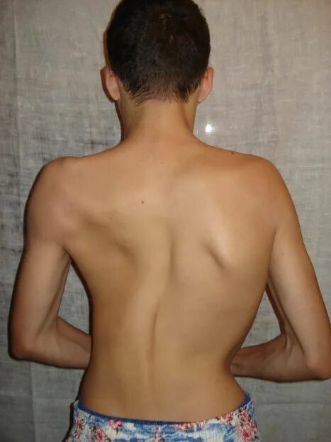 сколиоз 4 степени корсет шено. корсет шено шейерман мао. сколиоз 3-4 позвонка грудного отдела. правосторонний с образный сколиоз 2 степени. левосторонний грудопоясничный сколиоз.