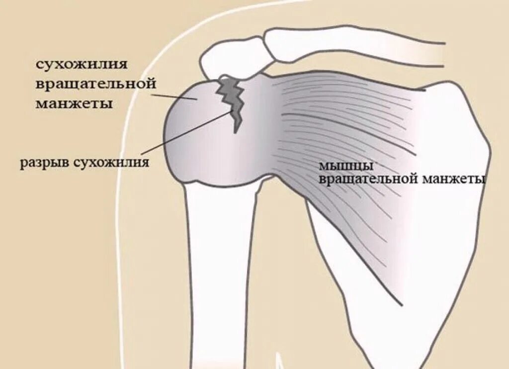 Ротаторная манжета плечевого сустава. Ротаторная манжета плечевого сустава анатомия. Повреждение ротаторная манжета. Ротаторная манжета плечевого сустава надрыв. Разрыв плечевого сустава симптомы