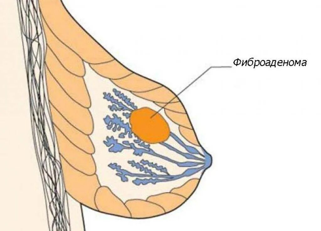 Фиброаденома молочной железы что это лечение. Фибра аденома молочной железы. Фиброма аденома молочной железы. Новообразование молочной железы фиброаденома. Кисты и фиброаденомы молочной железы.