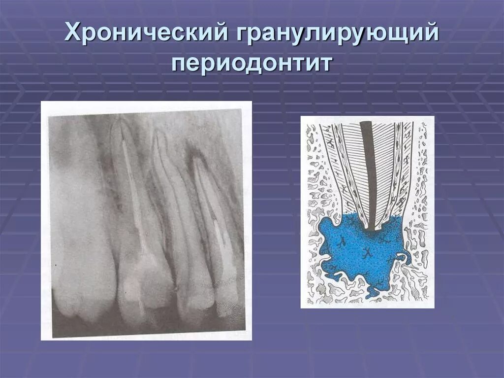 Фиброзный периодонтит. Хронический обострившийся периодонтит рентген. Гранулематозный апикальный периодонтит. Периодонтит фиброзный гранулематозный гранулирующий. Хронический апикальный периодонтит рентген.