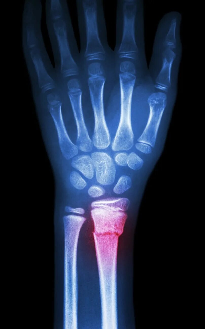 Radius fracture