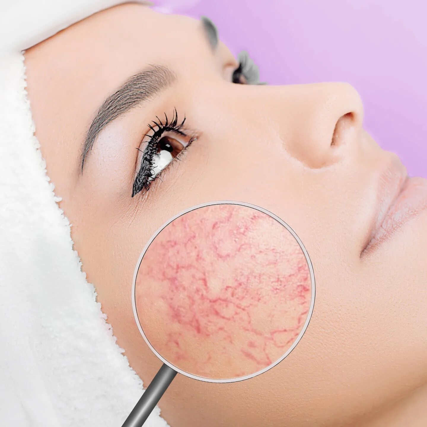 телеангиэктазии, купероз. Ipl аппарат lumecca. папулопустулярная розацеа. неровный тон кожи. гипертрофическая розацеа.