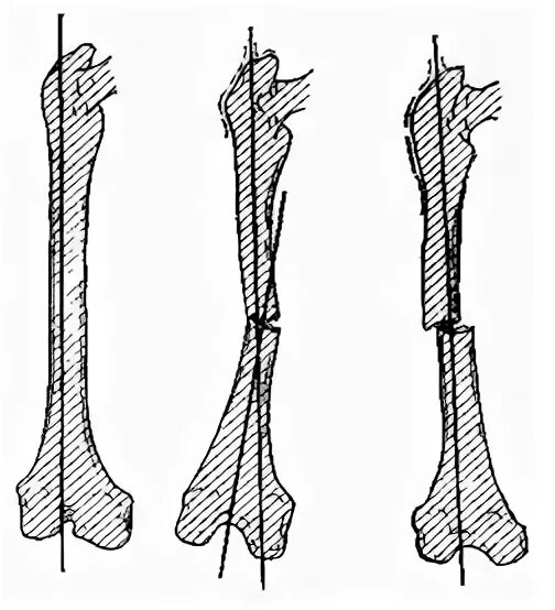 Искривление трубчатых костей. Дугообразное искривление кости. Ось кости. Изменение формы кости