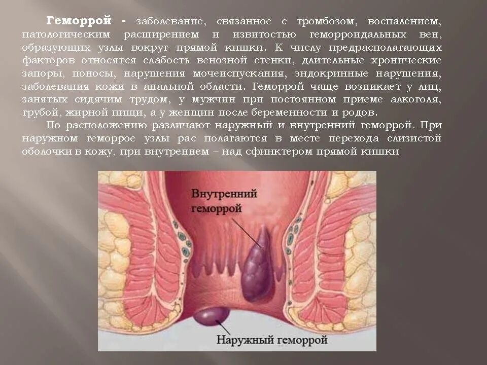 Ноющая боль в заднем проходе. Ноющая боль в заднем проходе