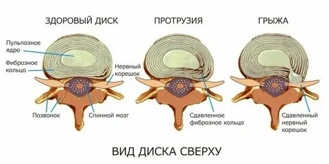 Пролабирование диска позвоночника что это