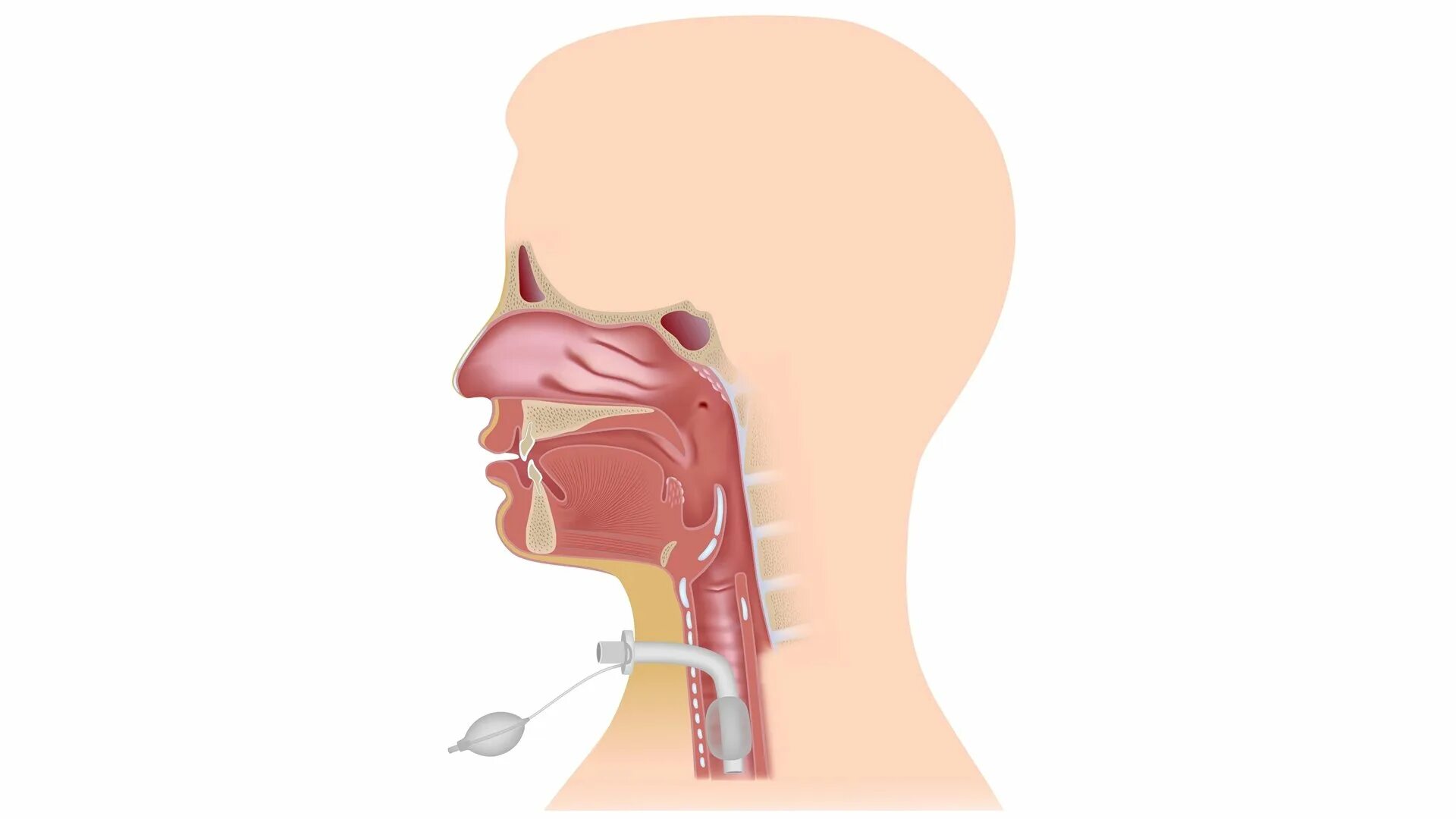 Чувствительность глотки. Трахеостомия трубка дыхательная. Искусственная гортань.