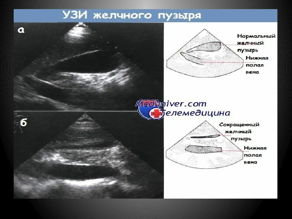 УЗИ анатомия желчного пузыря. УЗИ печени и желчного пузыря. Трактовка данных УЗИ печени и желчных путей. Анатомия печени и желчевыводящих путей по УЗИ. Узи сократимости желчного пузыря