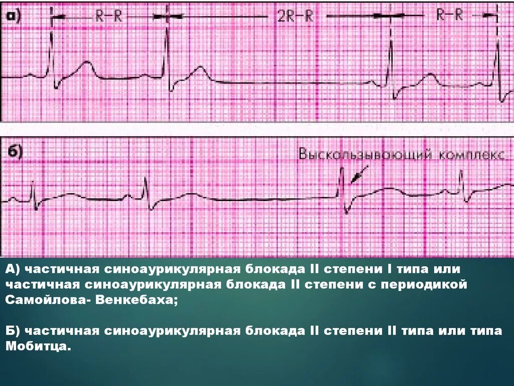 Са блокада 2 тип. Синоаурикулярная блокада 2-3 степени ЭКГ. Синоатриальная блокада без периодов Самойлова Венкебаха. Синоаурикулярная блокада 2 степени 1 типа. Синоатриальная блокада 2 степени на ЭКГ.