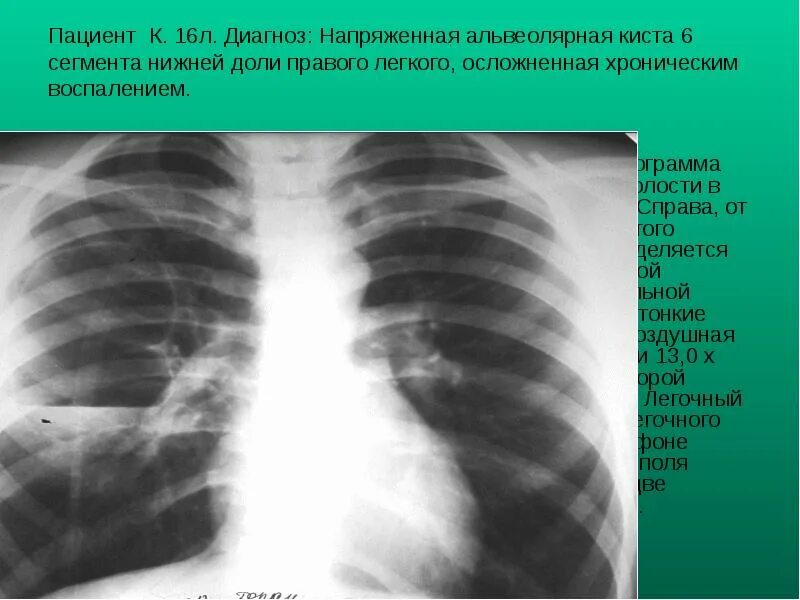 S6 в легких в правом легком. Киста нижней доли правого легкого. Синдром кольцевидной тени на рентгенограмме легких. Образование нижней доли правого легкого.