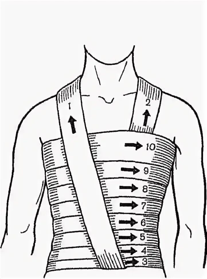 Техника наложения повязок на грудную клетку. Спиралевидная повязка на грудную клетку алгоритм. Техника наложения спиральной повязки на грудную клетку. Наложение спиральной повязки на грудную клетку алгоритм. Спиральная повязка на грудную клетку показания.