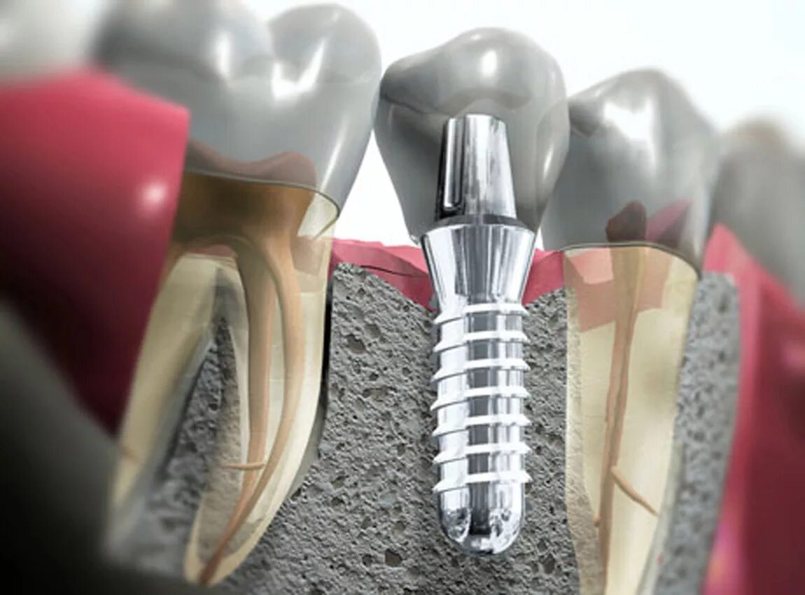 Имплант Osstem + имплантация. Импланты зубов Astra Tech. Штифт зубной анкерный. Осстем к 3.