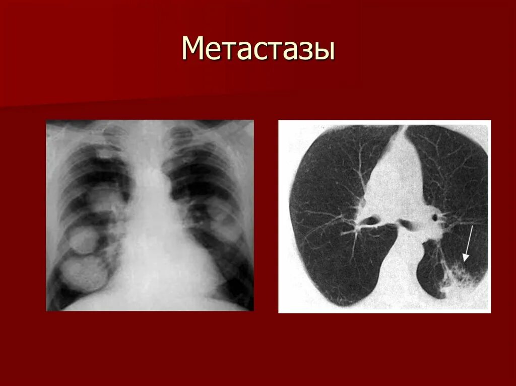 Метастазирование в легкие. Метастатические опухоли легких. 4 стадия злокачественная