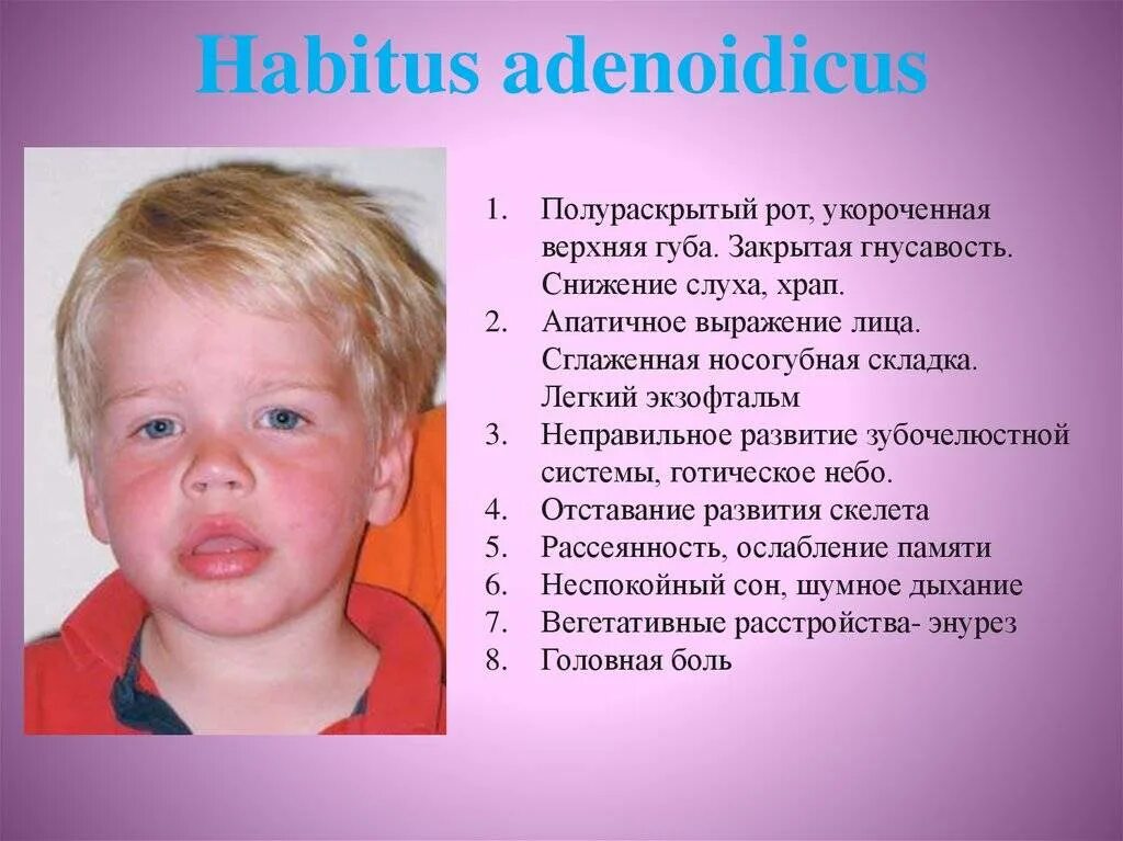 Как лечить аденоиды у ребенка 5. Симптомы аденоидов у детей. аденоиды у детей симптомы.
