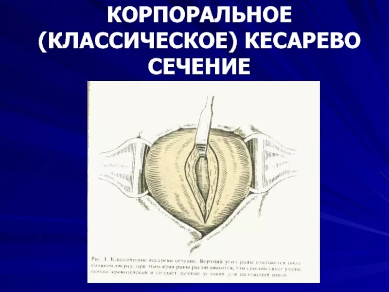 Техника кесарева сечения. Корпоральное кесарево сечение. Корпоральное кесарево сечение разрез. Техника корпорального кесарева сечения. Корпоральное (классическое) кесарево сечение.