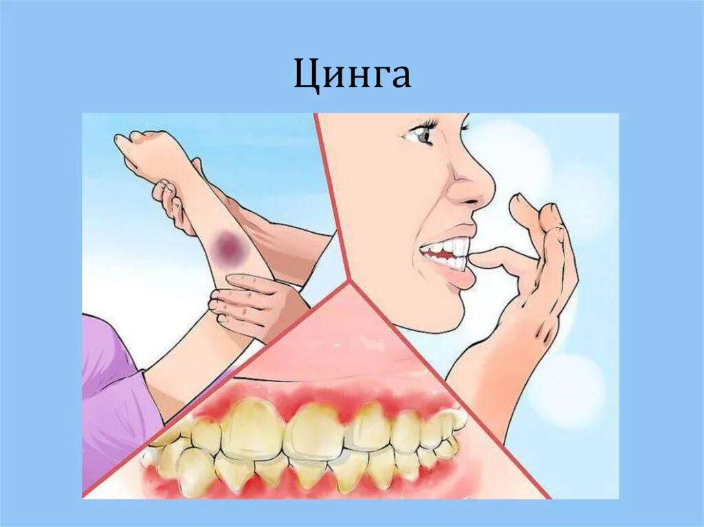 Ценга. Цинга при нехватке витамина. Цинга (дефицит витамина с). Цынг.