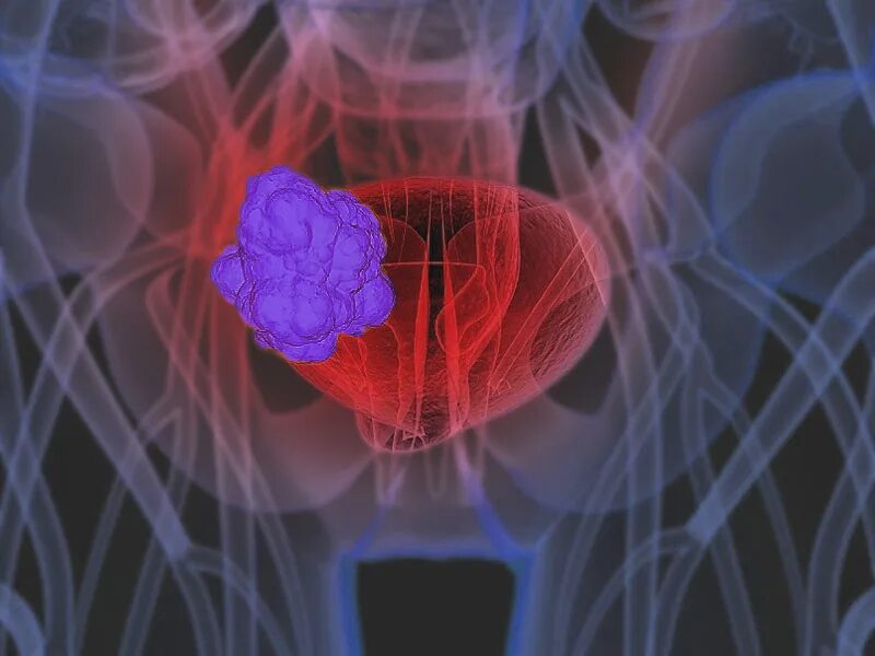 Онкология мочеполовой системы. Опухоль мочевого пузыря. Профилактика злокачественных новообразований мочевого пузыря. Злокачественная опухоль мочевого пузыря.