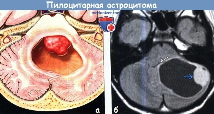 Пилоидная астроцитома. Пиломиксоидная астроцитома. Астроцитома головного мозга гистология. Пилоцитарная астроцитома. Пилоцитарная астроцитома мозжечка.