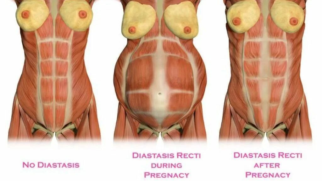 Диастаз после беременности. Диастаз брюшной стенки. Диастаз мышц белой линии живота. Диастаз прямой мышцы живота. Диастаз мышц брюшного пресса после родов.