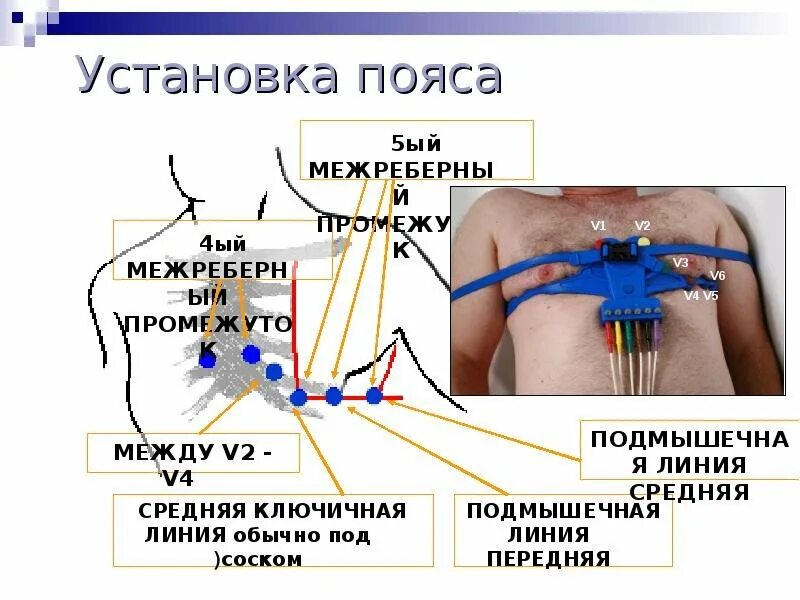 Схема накладывать электроды ЭКГ. ЭКГ электроды 5 электродов. Монитор ЭКГ 3х канальный наложение электродов. Крепление электродов ЭКГ. Соп экг