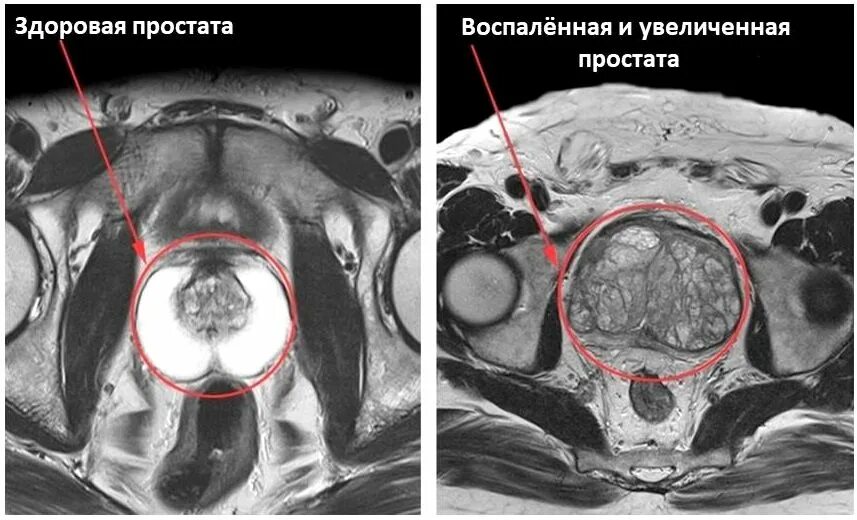 Мрт предстательной железы. Магнитно-резонансная томографии (мрт) предстательной железы. Гиперплазия предстательной железы мрт. Мультипараметрическое мрт предстательной железы. Подозрения на простату