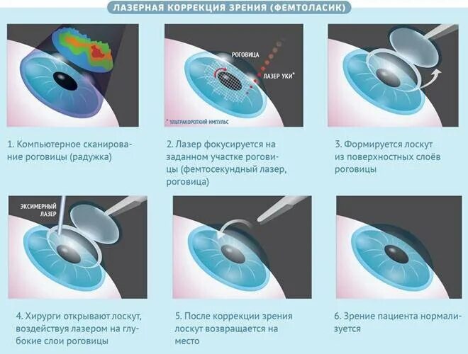 Лазерная рефракционная кератопластика (методом Femto super LASIK). Ласик схема операции. Фемто ласик этапы. Коррекция зрения цена clinicaspectr ru