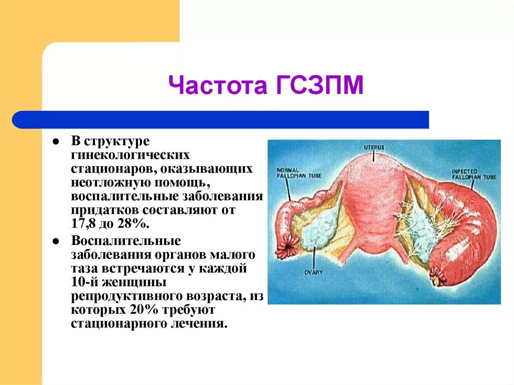 Воспаление придатков как называется